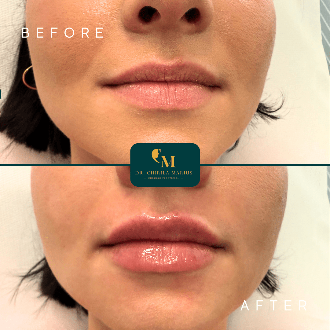 Mărirea buzelor cu acid hialuronic rezultate before & after