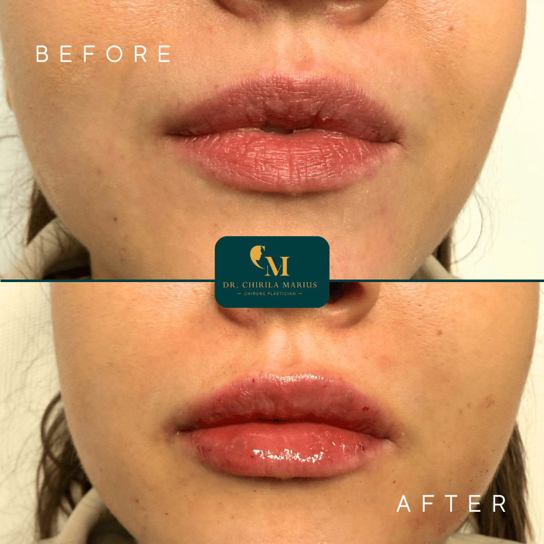 Rezultate before & after mărire buze cu acid hialuronic