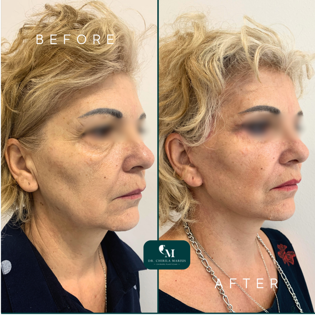 Lifting facial rezultate before and after