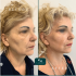 Lifting facial rezultate before and after
