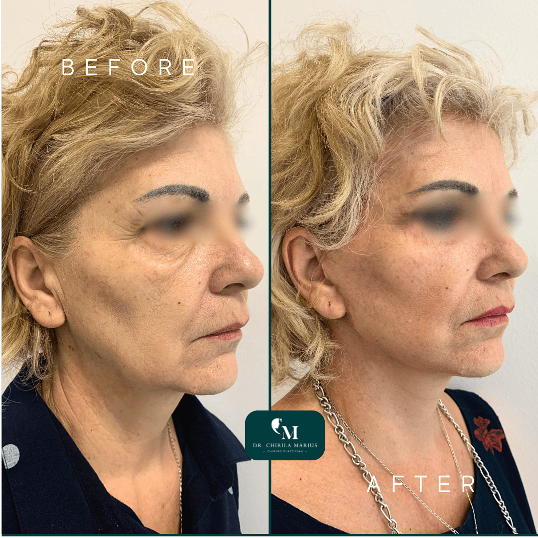 Lifting facial rezultate before and after