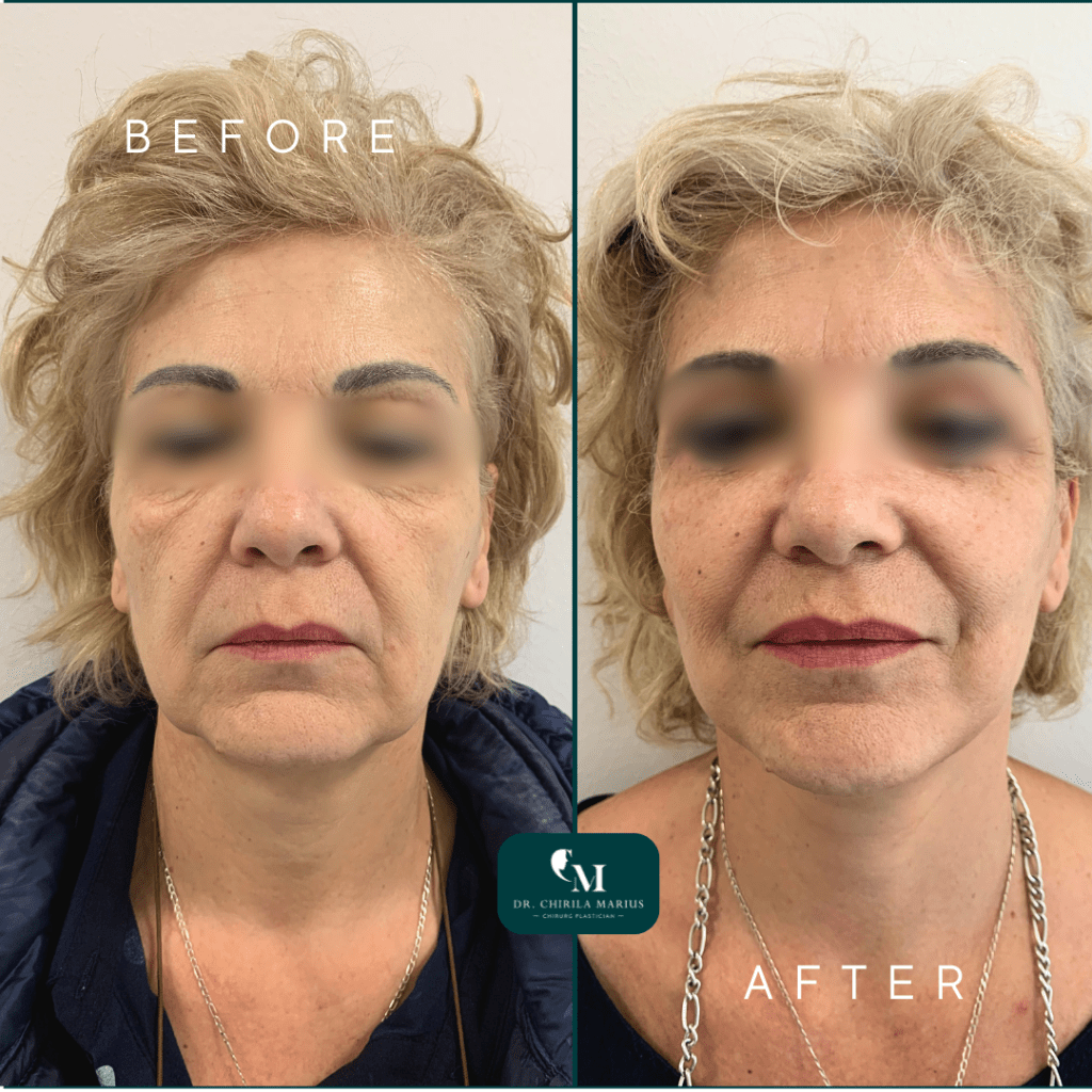 Lifting cervico-facial rezultate before & after