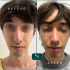 Rinoseptoplastie rezultate before & after