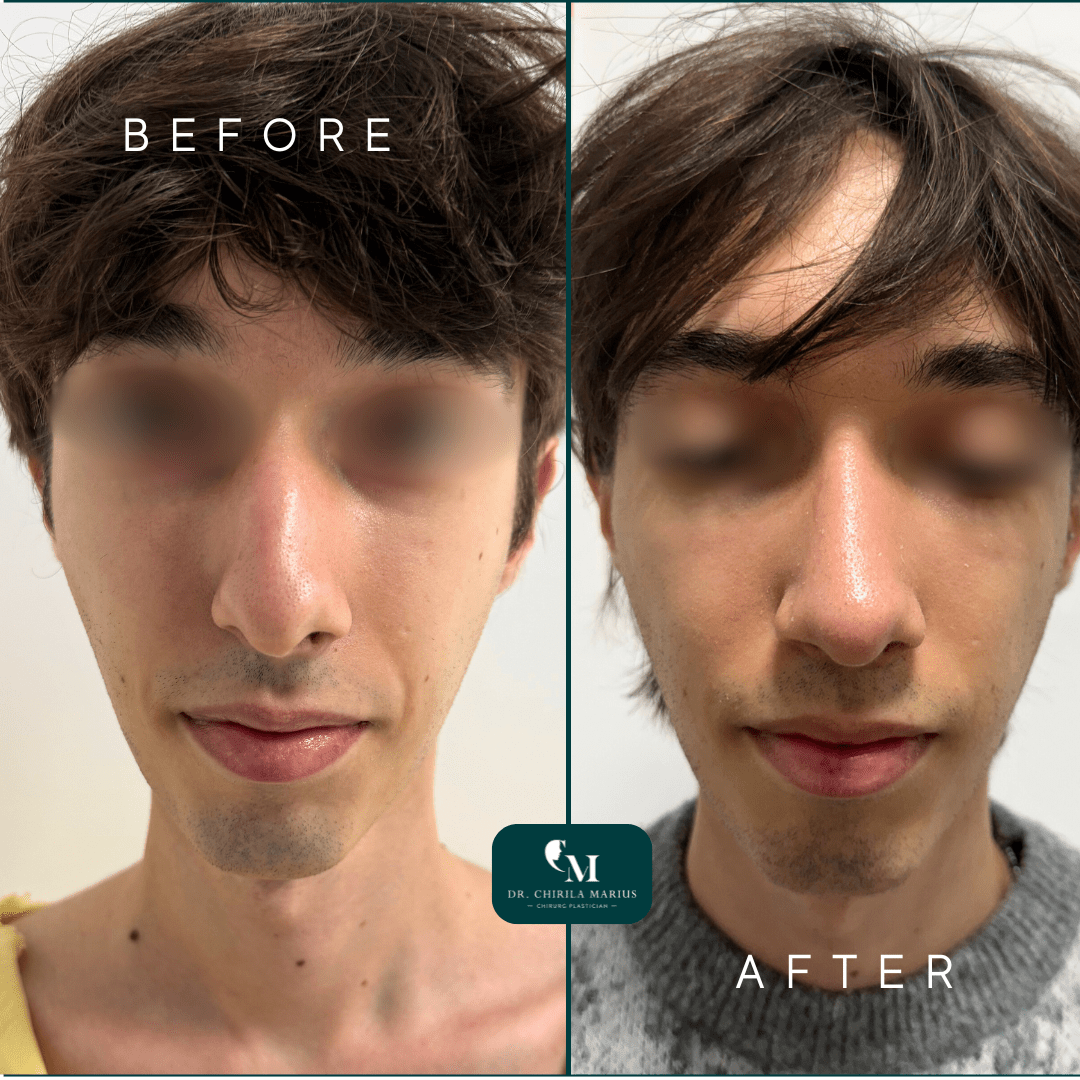 Rinoseptoplastie rezultate before & after