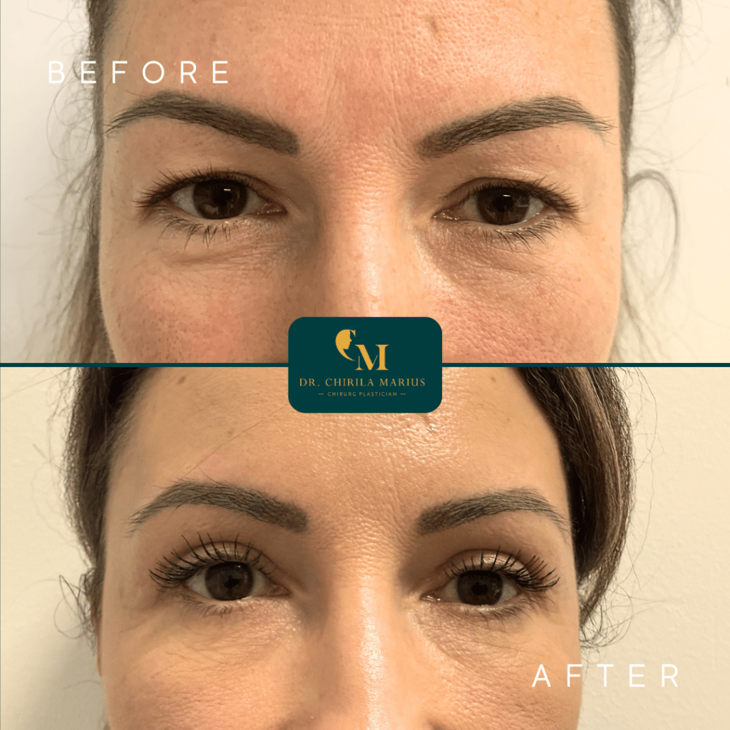 Blefaroplastie rezultate before & after
