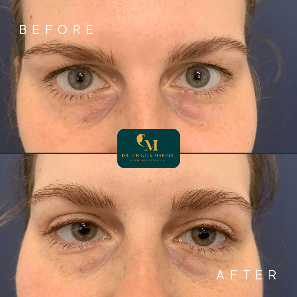 Blefaroplastie rezultate before & after