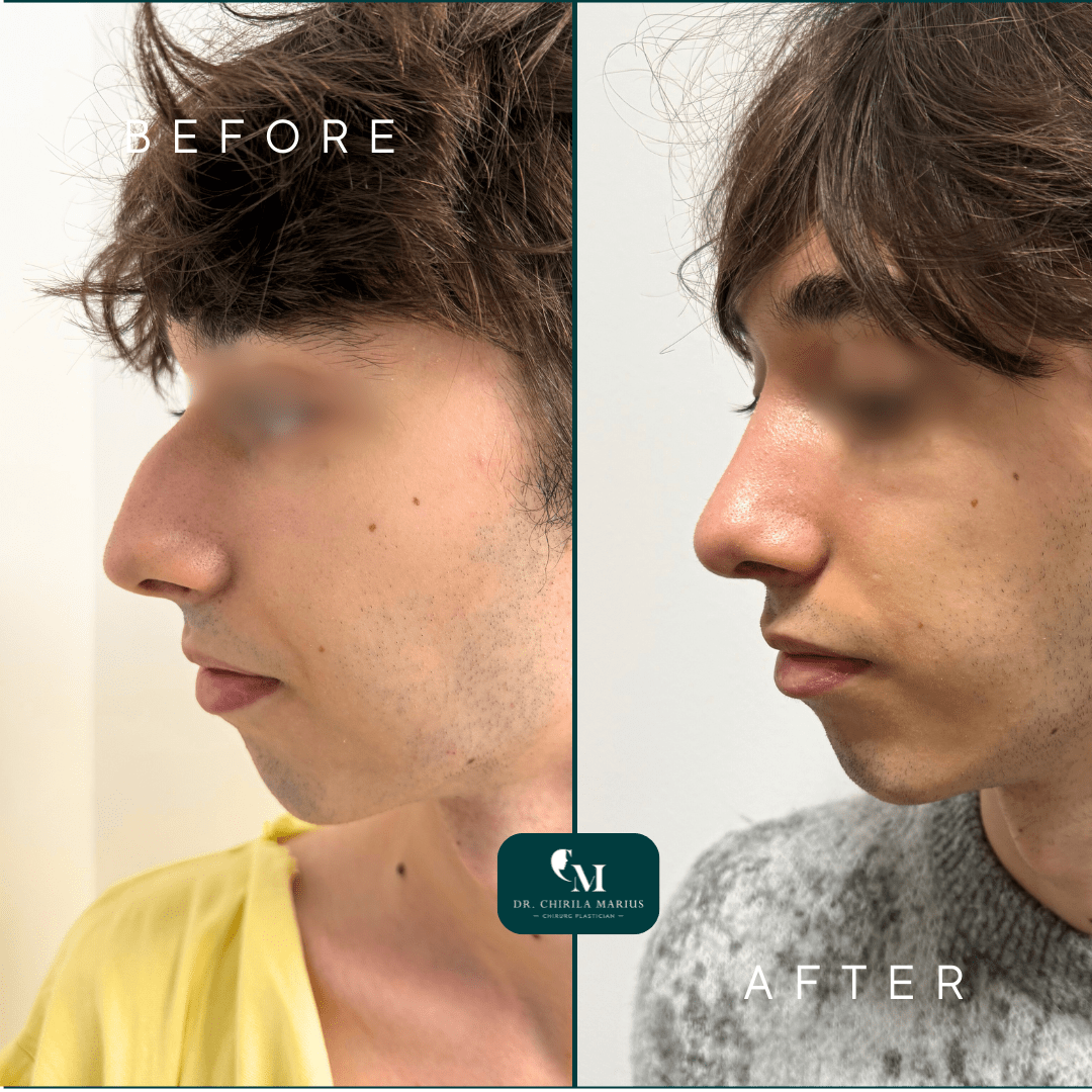 Rinoplastia structurală rezultate before & after