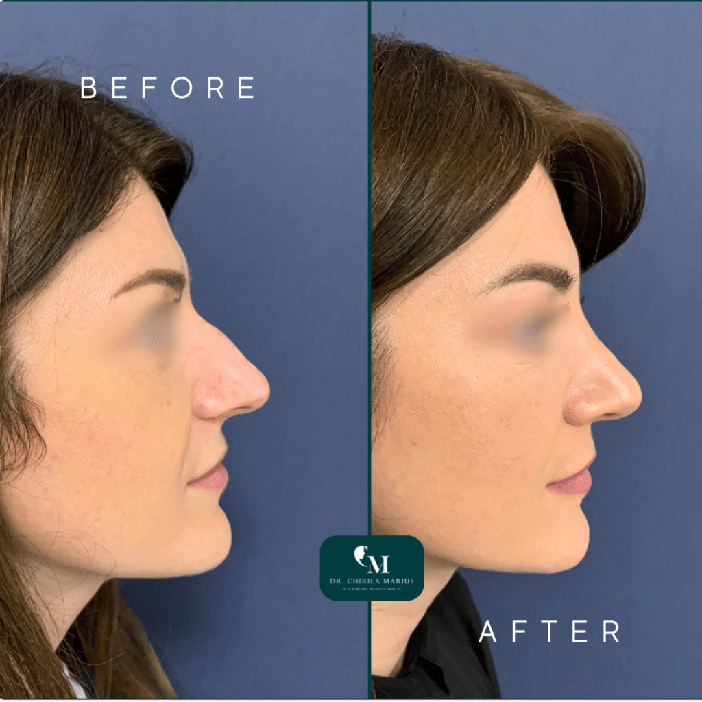 Rinoplastia structurală rezultate before & after
