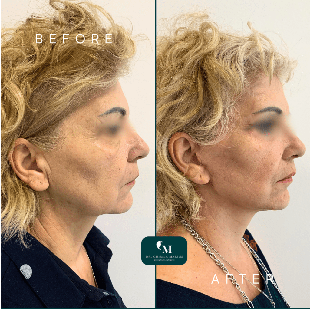 Lifting cervico-facial rezultate before and after