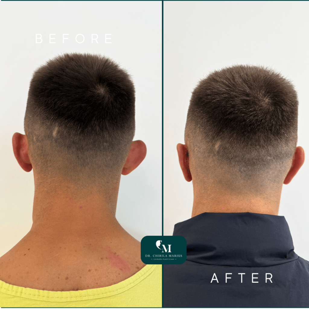Otoplastie rezultate before and after