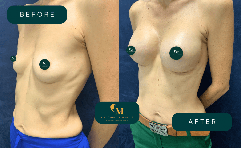 Augmentare mamară rezultat before & after